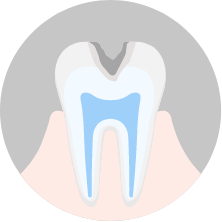 象牙質まで侵されている虫歯