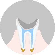 歯根部まで侵されている虫歯